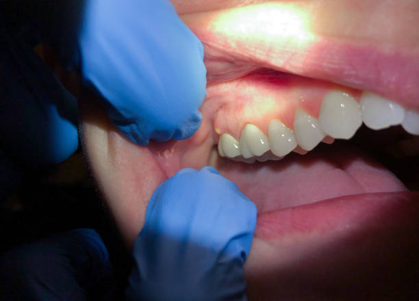 Best Emergency Broken Tooth Repair in Cedar Hill, TX